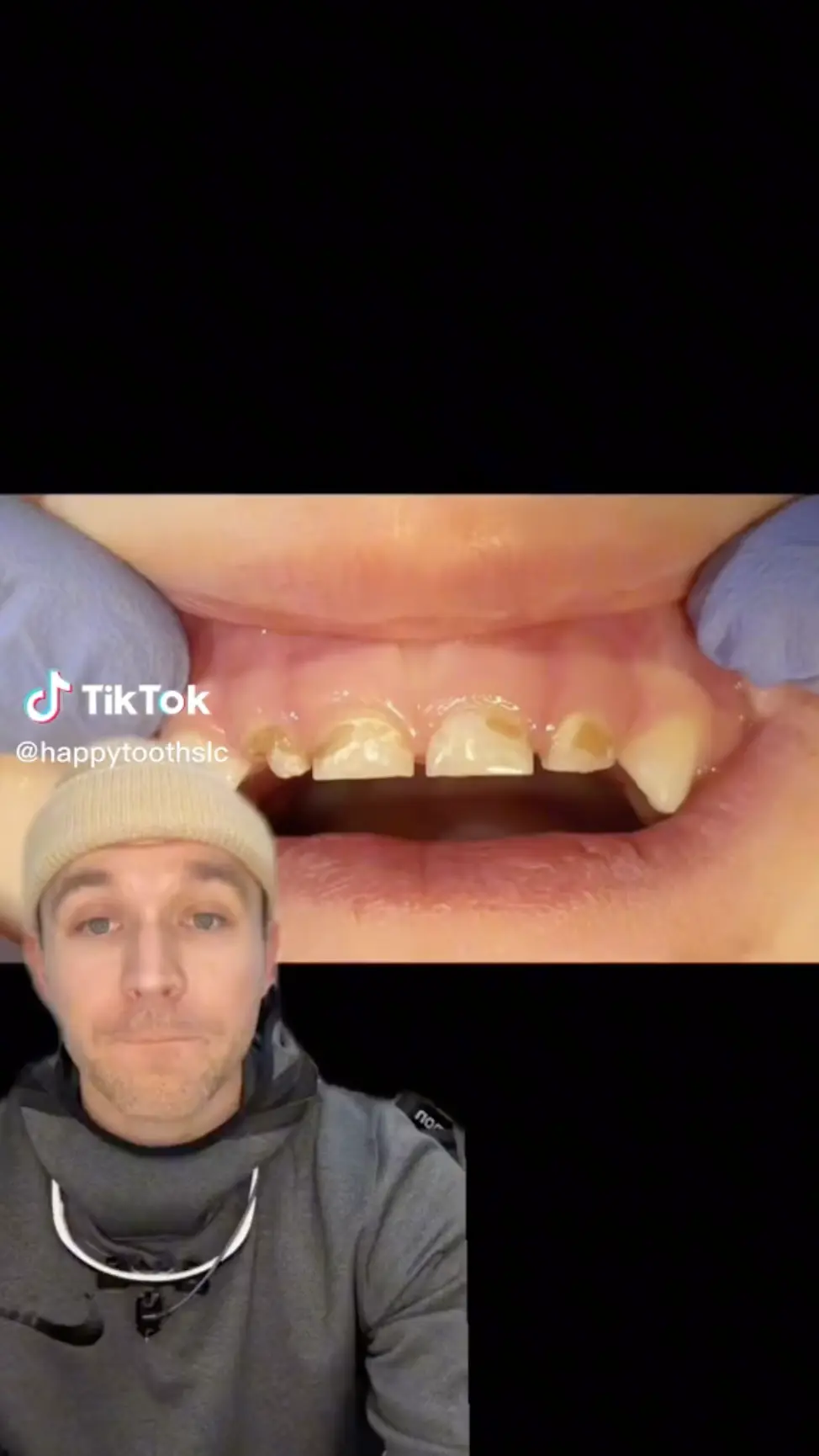 clip on braces for teeth｜TikTok Search